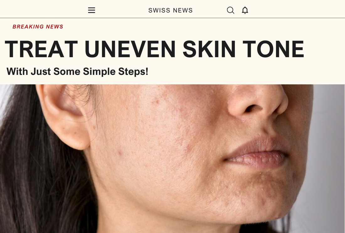 Causes Of Uneven Skin Tone And Recommended Serums To Treat It