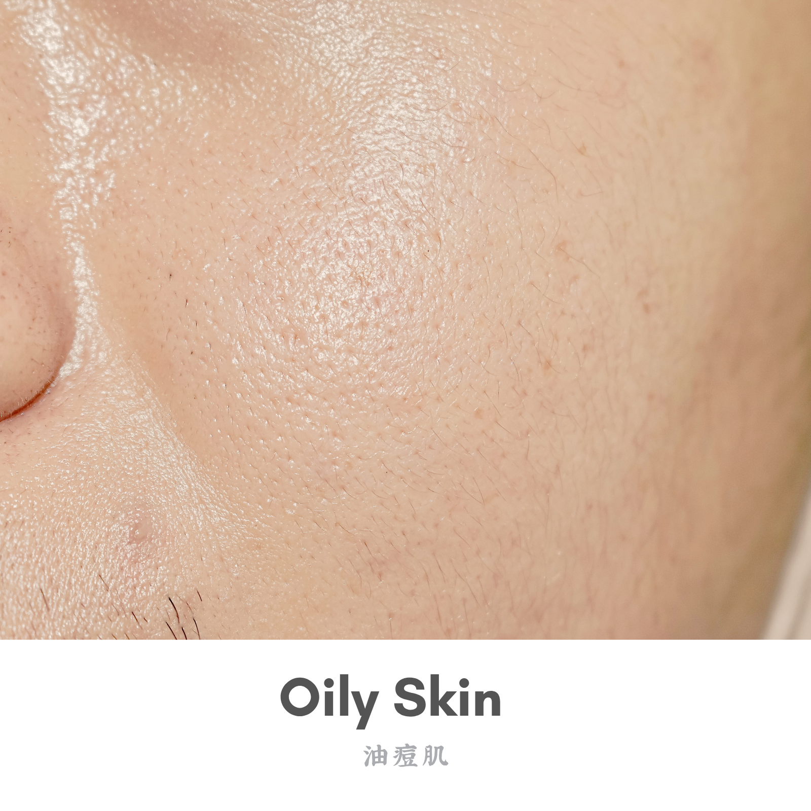 Oily Skin