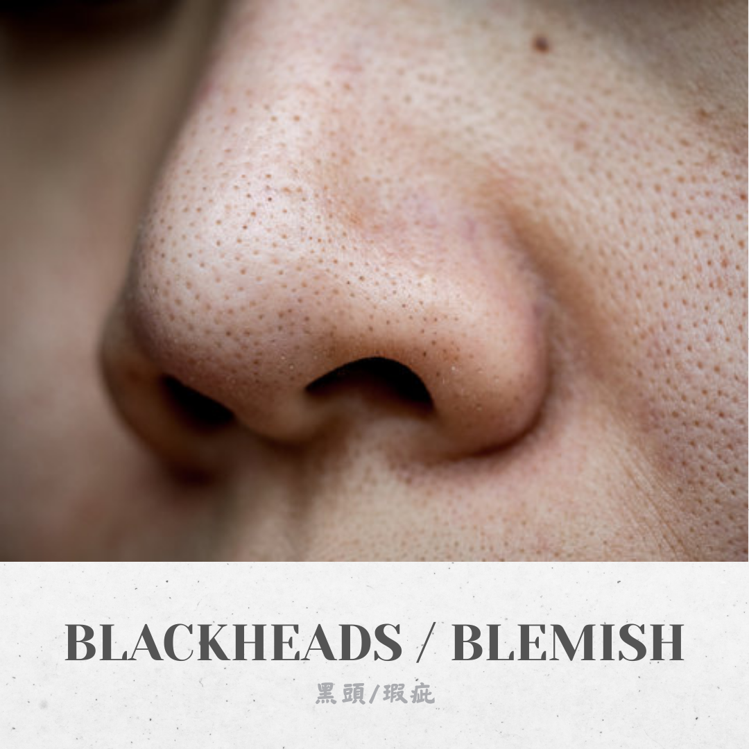 Blackheads / Blemish