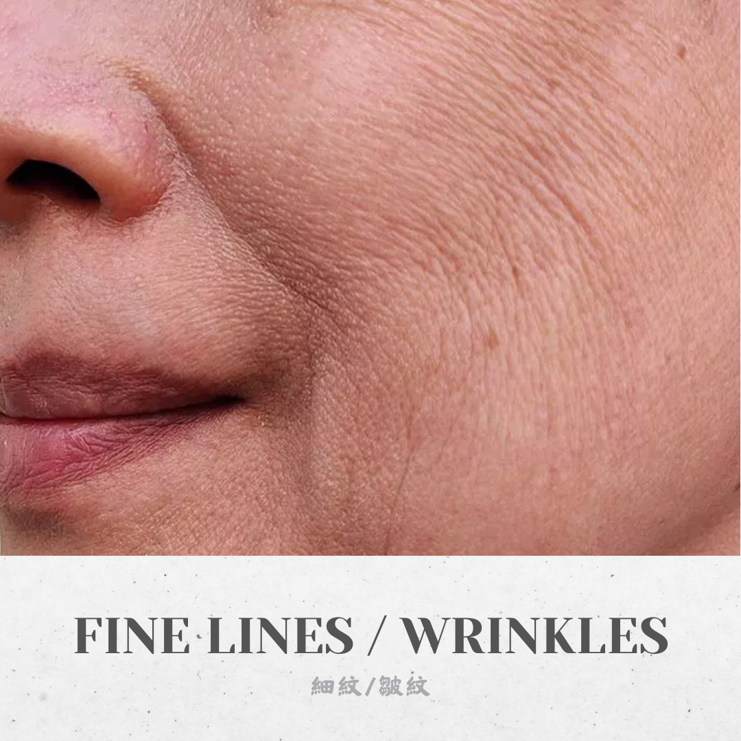 Anti-aging / Wrinkles