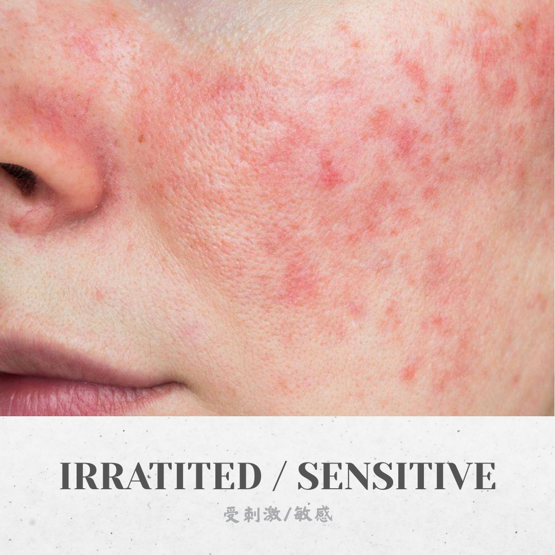 Irritated / Sensitive