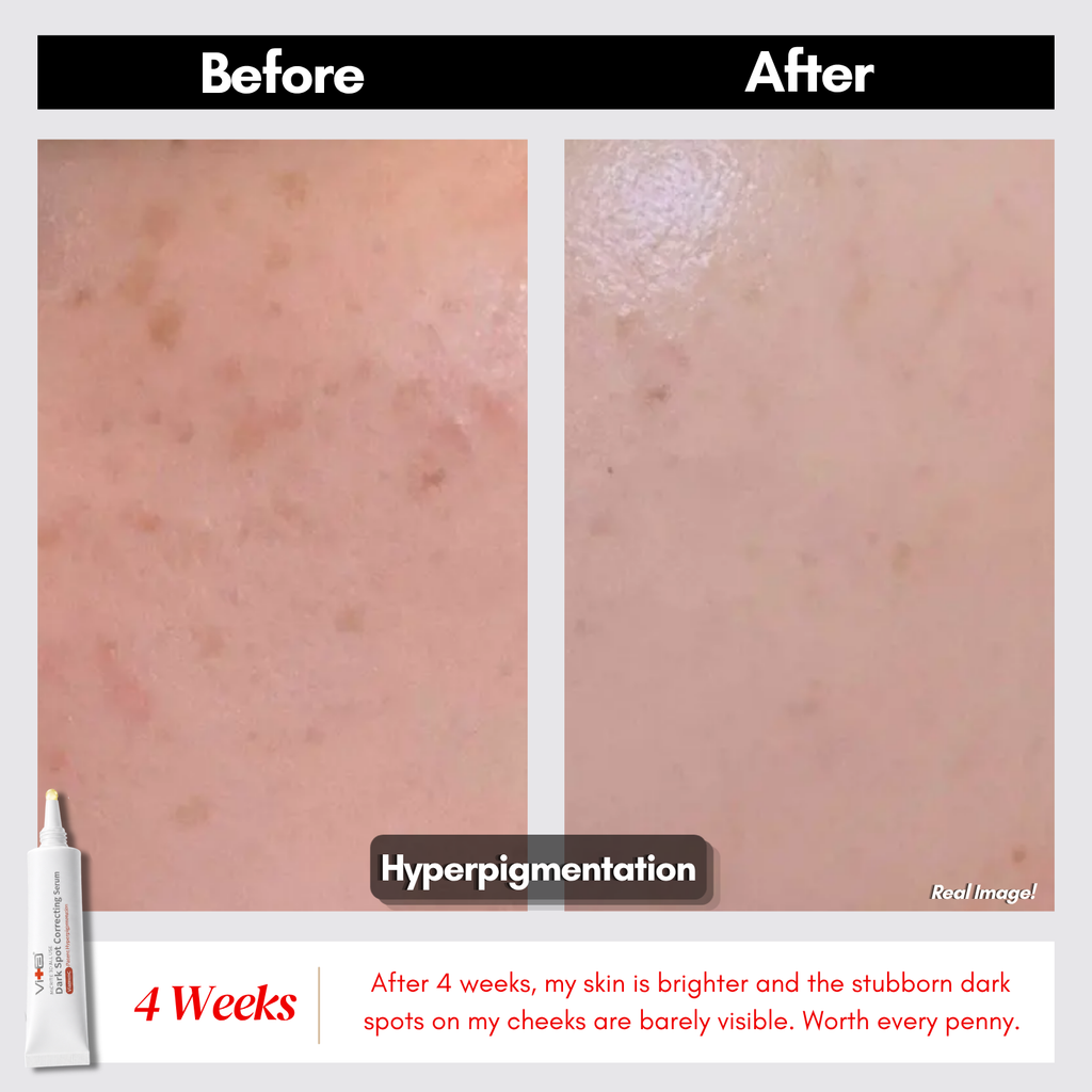 【Buy 1 Free 1】Dark Spot Duo - Swissvita Dark Spot Correcting Serum (15g) x 2pcs