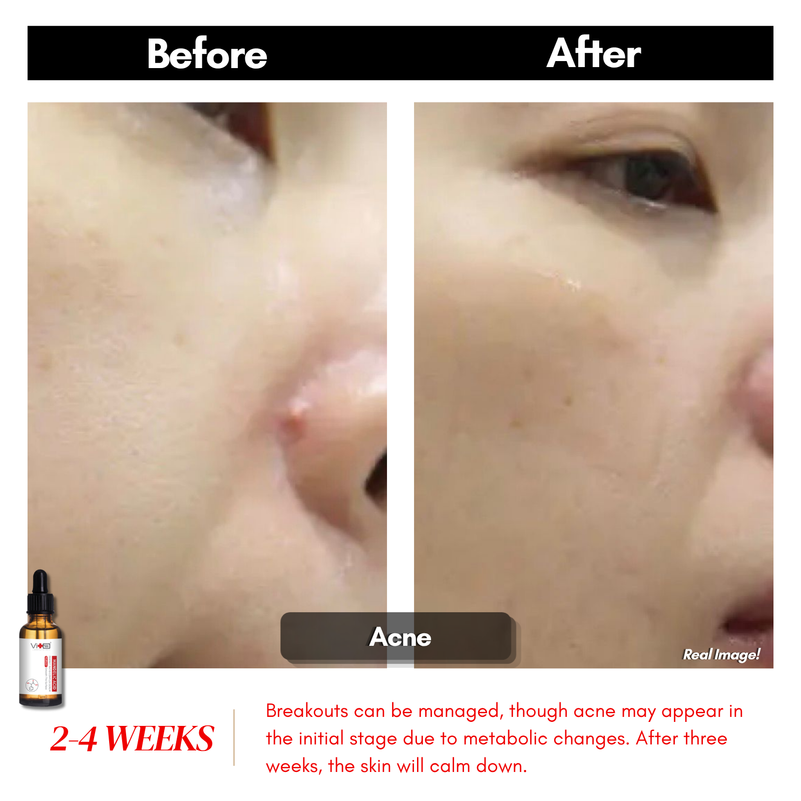 【Buy 1 Free 1】Gentle Exfoliation - Swissvita Mandelic Acid Serum (30ml) x 2pcs