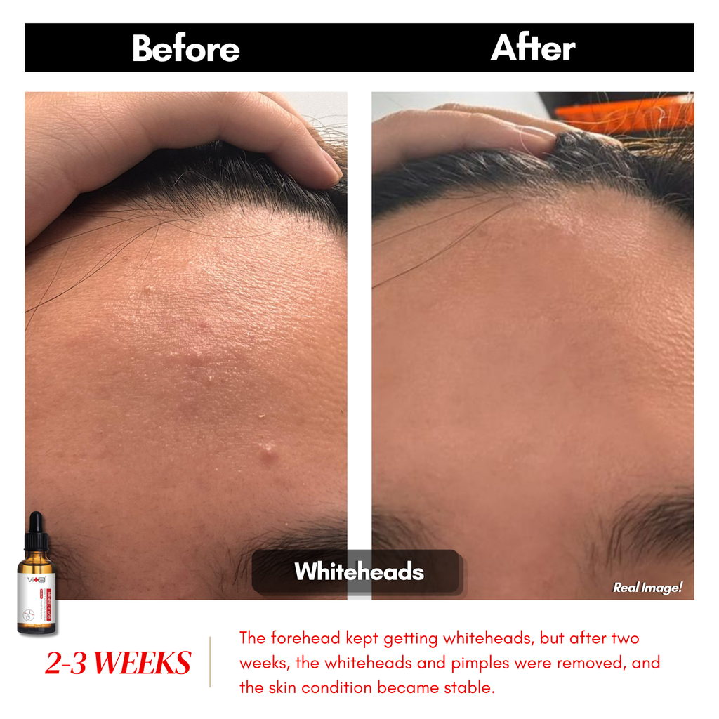 【买一送一】Swissvita Mandelic Acid Perfect Ratio Complex Serum - 30ml (VitaBtech) 薇佳蜜花酸晶焕肤美白精萃(VitaBtech升级版) 30ml
