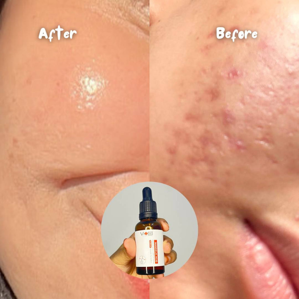 【买一送一】Swissvita Mandelic Acid Perfect Ratio Complex Serum - 30ml (VitaBtech) 薇佳蜜花酸晶焕肤美白精萃(VitaBtech升级版) 30ml